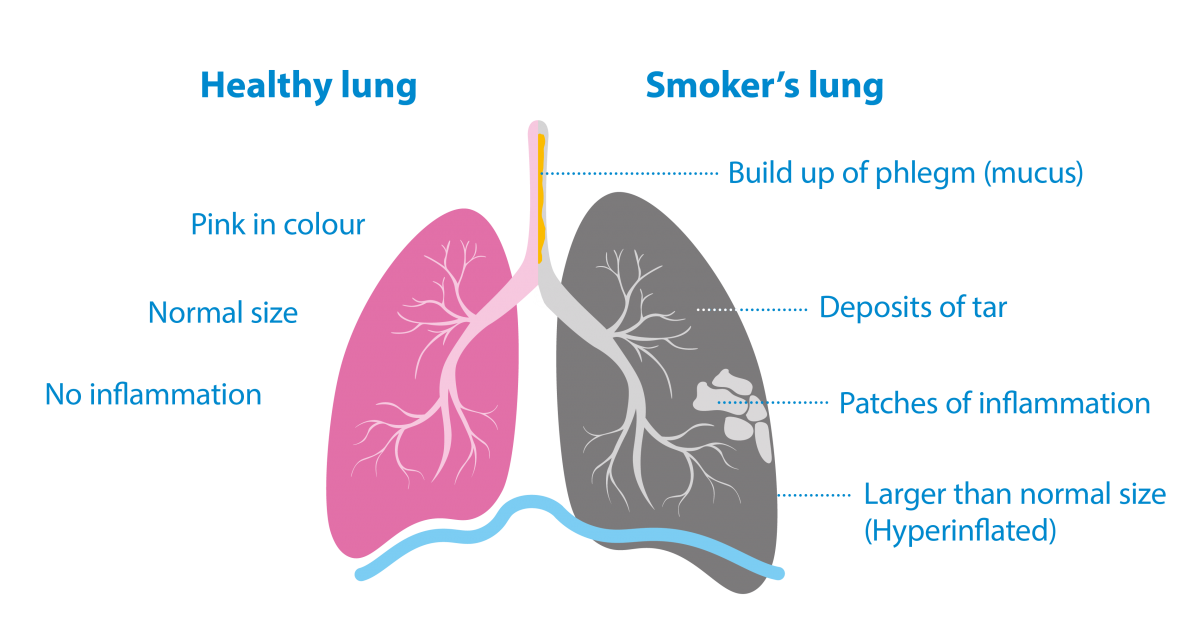 /Image%20showing%20the%20difference%20between%20a%20healthy%20lung%20and%20a%20smoker%27s%20lung