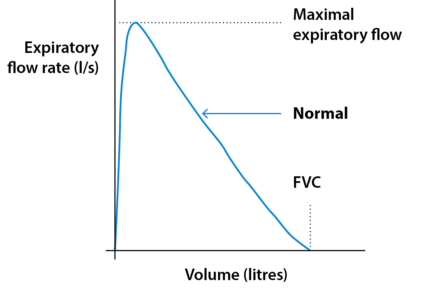 Spirometry and bronchodilator responsiveness testing Asthma + Lung UK